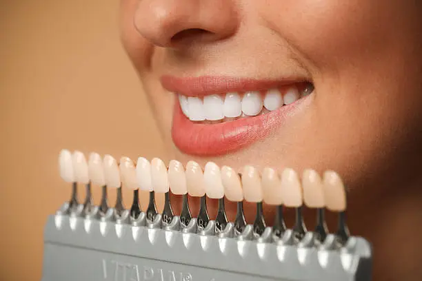 Sorriso perfetto con trattamenti di estetica dentale — Studio Dentistico Dr. Frozzi